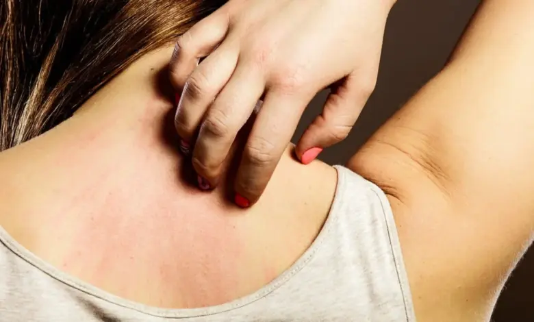 Rritje alarmante e alergjive në Kumanovë  Si t i njohim simptomat dhe të shmangim ndërlikimet 